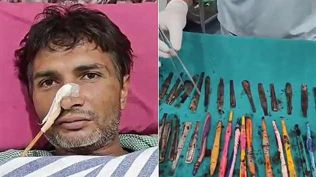 Muž kvůli hladu polykal příbory a kartáčky. Málem ho to stálo život