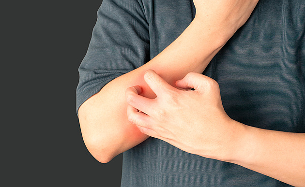 Jak zkrotit ekzém. Vyvarujte se těchto chyb a zvolte správnou péči